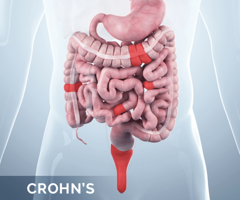 crohns Maladie de Crohn et risque de cancer colorectal