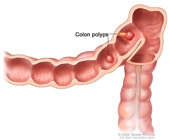 PolypsNoPhoto Qu’est-ce que le cancer colorectal ?